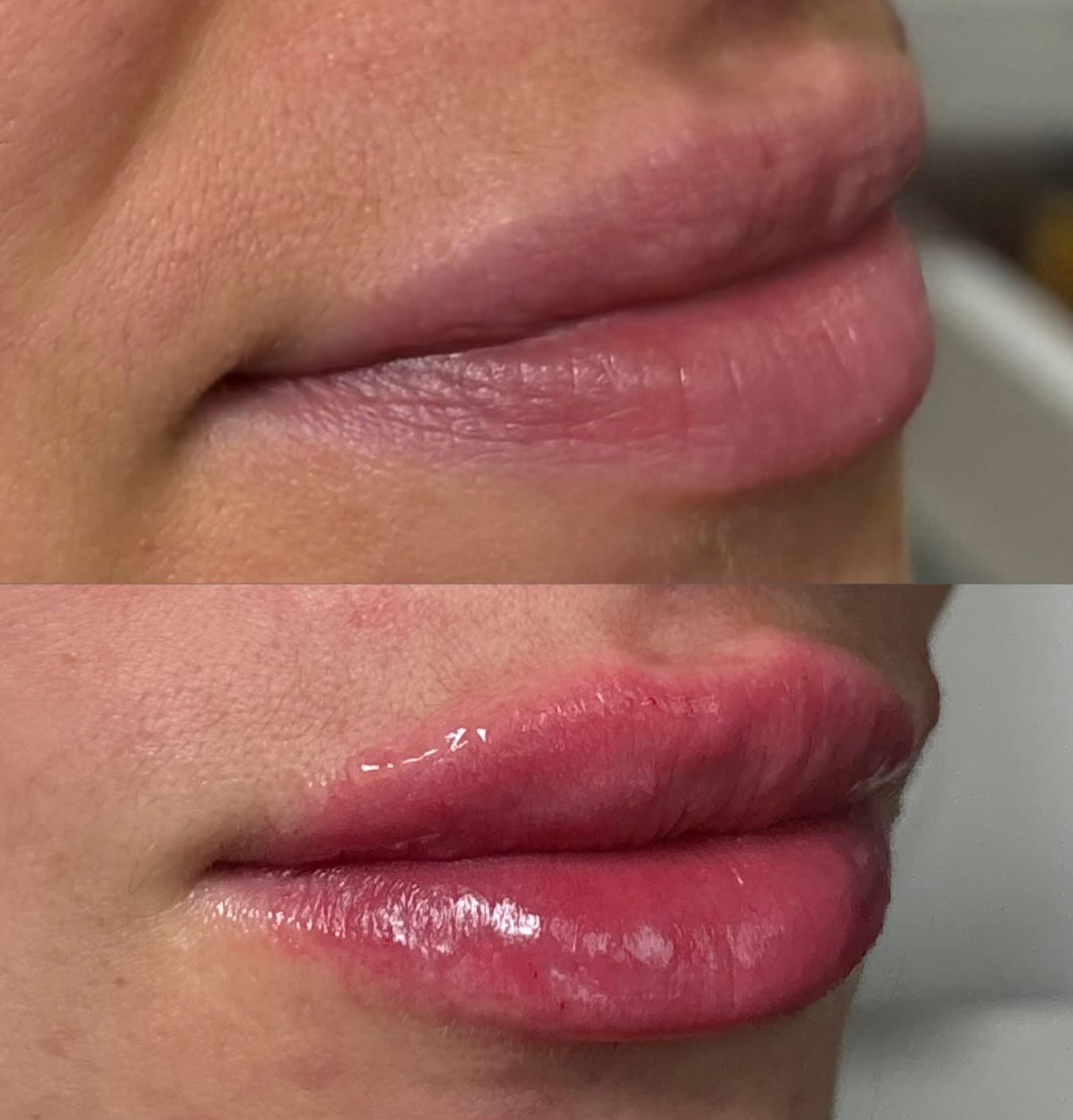 injectables-gallery-6